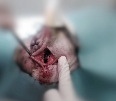 hernia cerrada por dentro