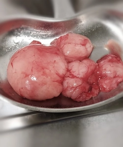 lipoma extirpado