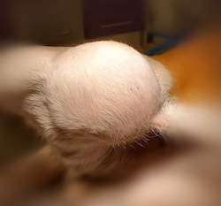 lipoma