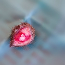 osteocondroma extirpado