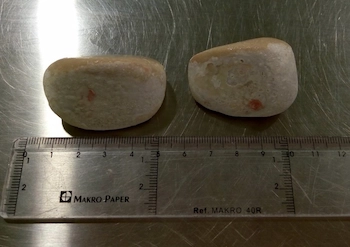 piedras extraidas de la vejiga