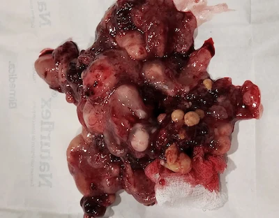 liposarcoma extirpado