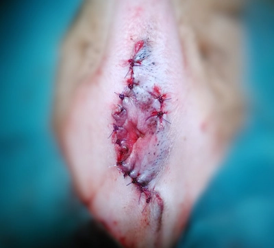 Tumor extirpado