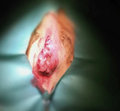 Tumor perianal