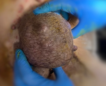tumor de mama